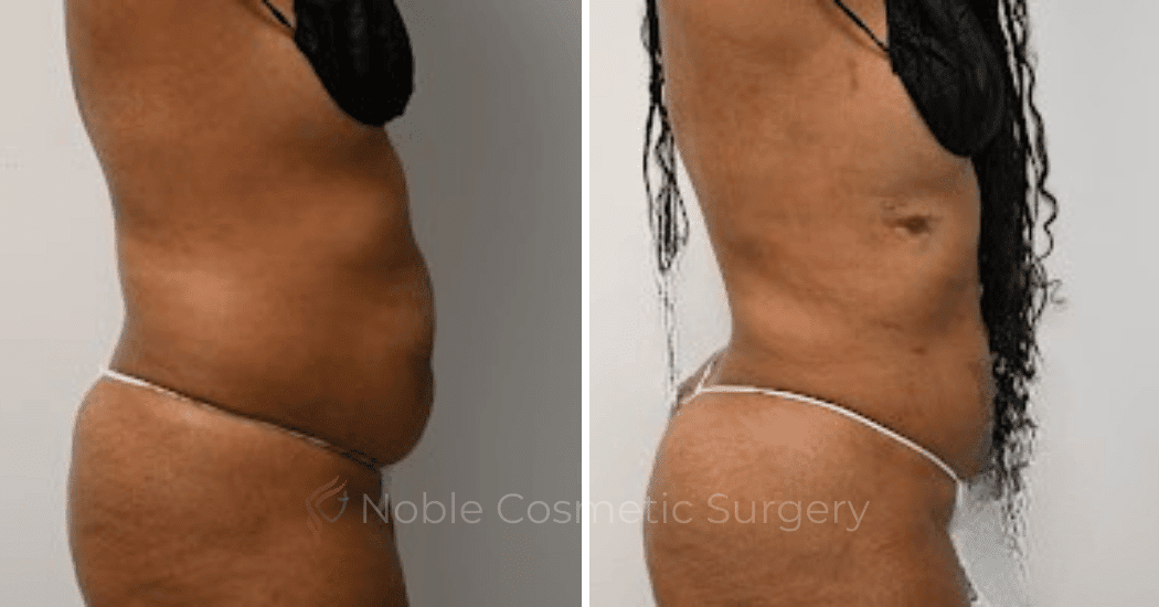 LIPOSUCTION-CASE-10929 | Before and After Liposuction 3