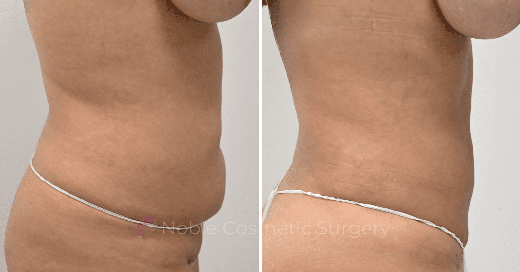 LIPOSUCTION-CASE-12977 | Before and After Liposuction 3