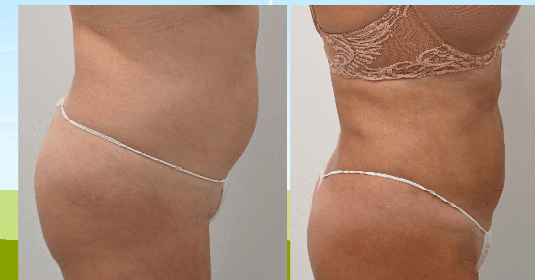 LIPOSUCTION-CASE-13006 | Before and After Liposuction 3