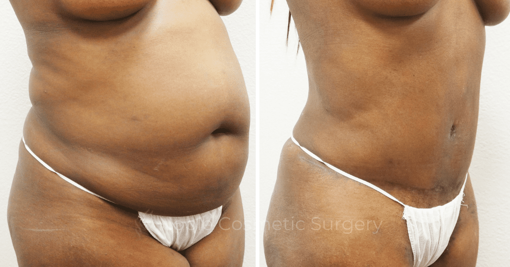 MOMMY-MAKEOVER-CASE-00305 | Before and After Mommy Makeover 2