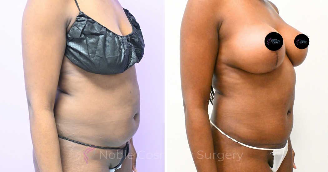 Case--20347 | Before and After Abdominoplasty 3