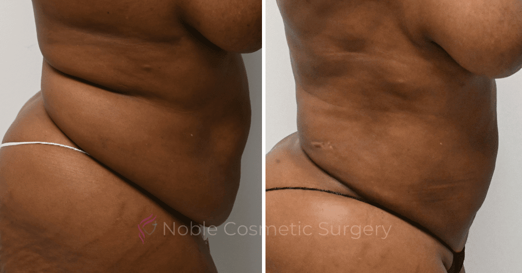 LIPOSUCTION-CASE-13371 | Before and After Liposuction 3