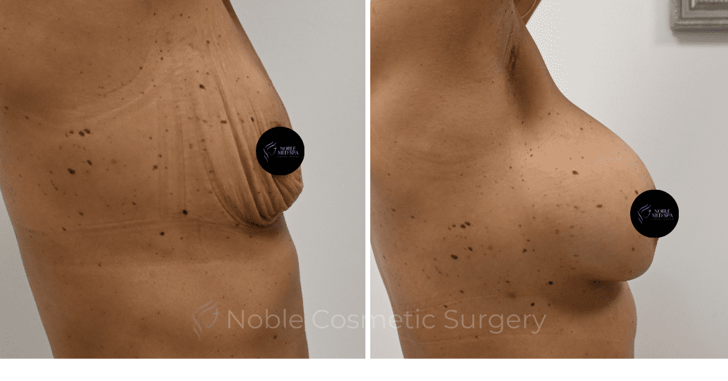BREAST-AUGMENTATION-CASE-13021 | Before and After Breast Augmentation 3