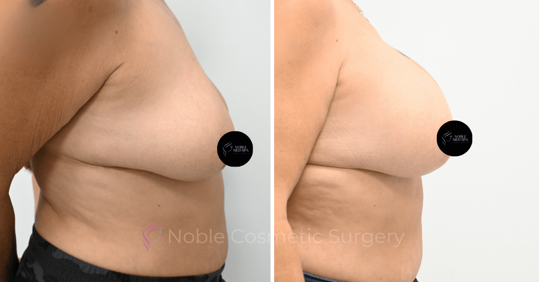 BREAST-AUGMENTATION-CASE-12478 | Before and After Breast Augmentation 2
