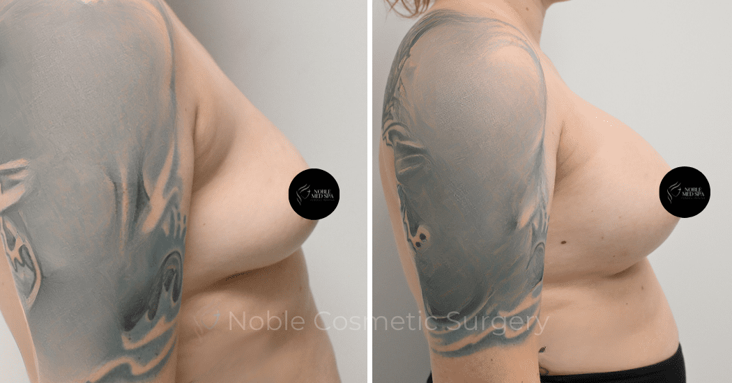 BREAST-AUGMENTATION-CASE-11771 | Before and After Breast Augmentation 4