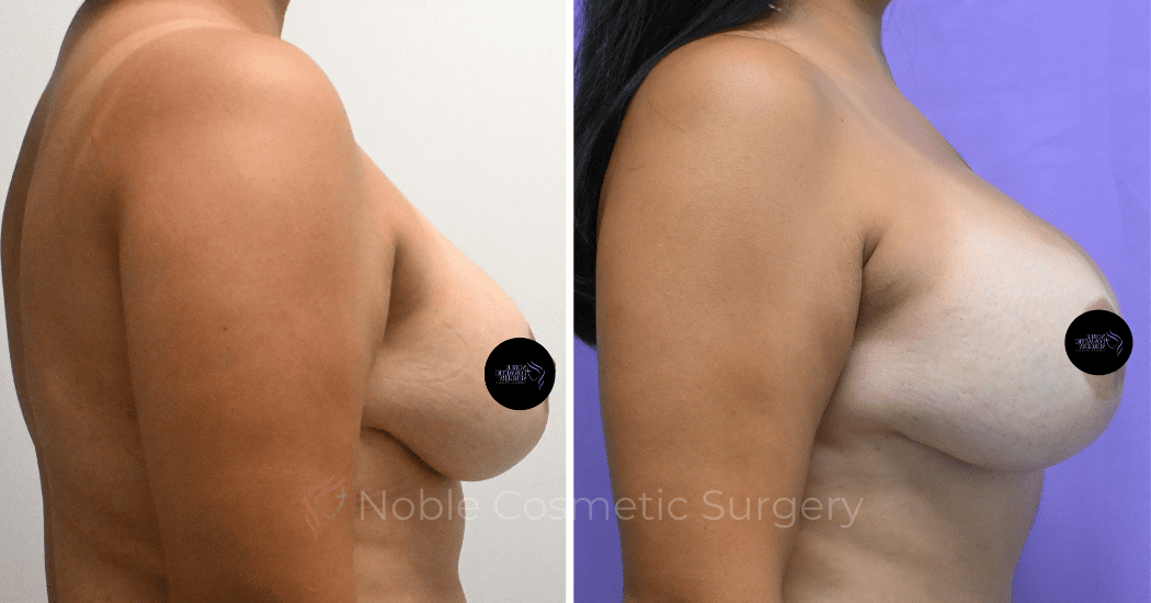 BREAST-AUGMENTATION--CASE-00310 | Before and After Breast Augmentation 3