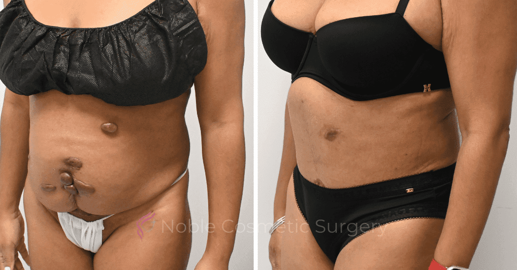 TUMMY-TUCK-CASE-10972 | Before and After Abdominoplasty 3