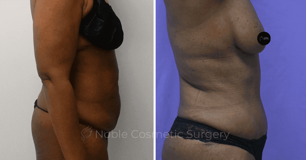 TUMMY-TUCK-CASE-10375 | Before and After Abdominoplasty 3
