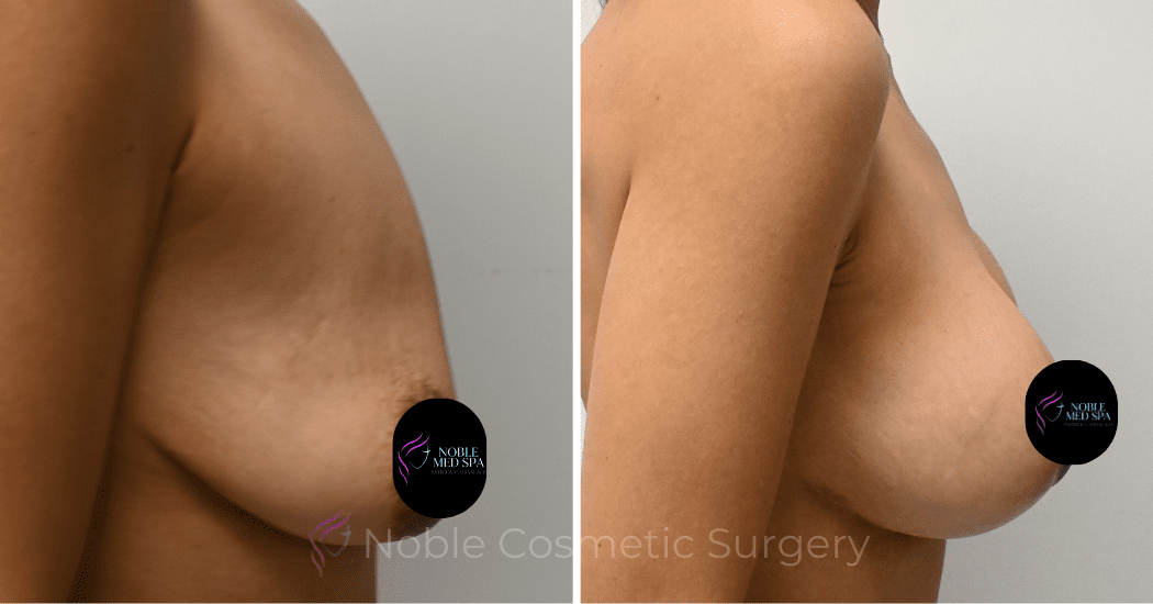 BREAST-AUGMENTATION-WITH-LIFT-CASE-10931 | Before and After Breast Augmentation with Lift 3