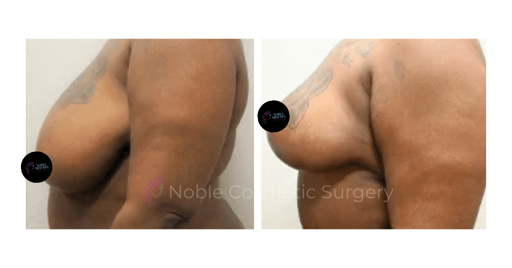 BREAST-REDUCTION-CASE-18364 | Before and After Breast Reduction 3