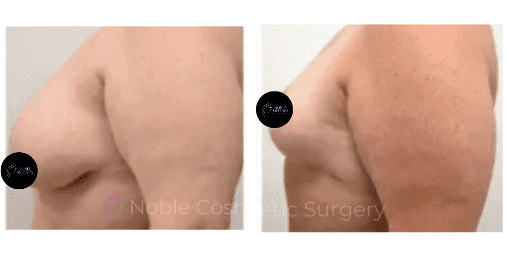 BREAST-REDUCTION-CASE-19223 | Before and After Breast Reduction 2