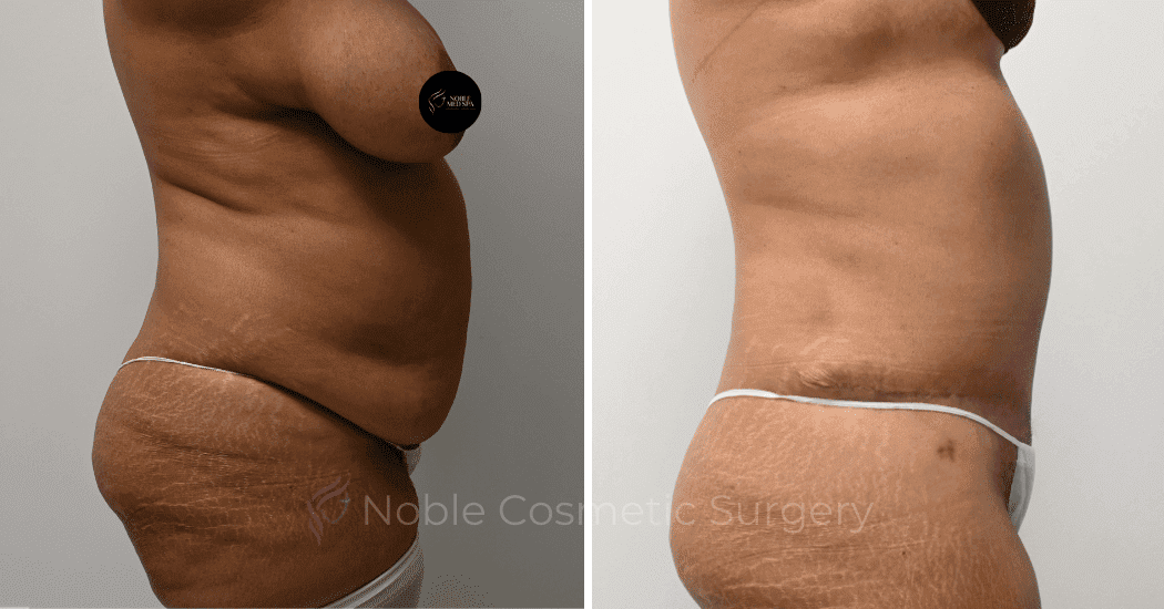 TUMMY-TUCK-CASE-11110 | Before and After Abdominoplasty 3