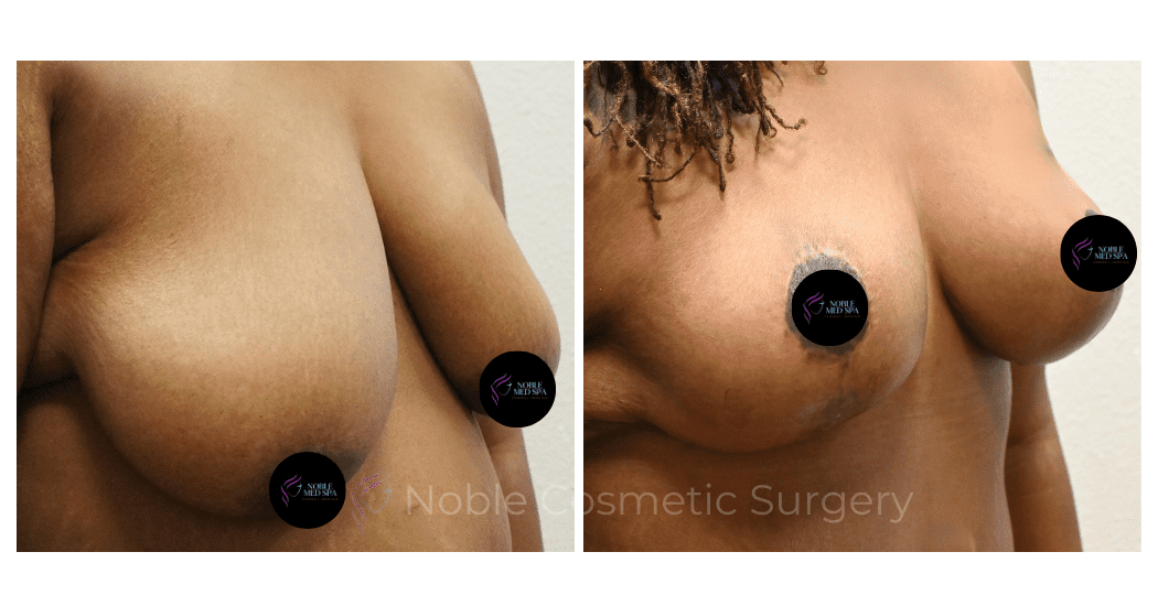 BREAST-REDUCTION-CASE-00801 | Before and After Breast Reduction 2
