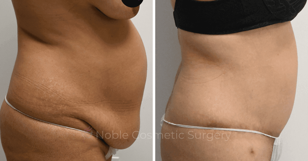 TUMMY-TUCK-CASE-11285 | Before and After Abdominoplasty 3