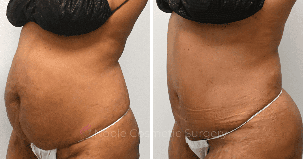 TUMMY-TUCK-CASE-10626 | Before and After Abdominoplasty 3