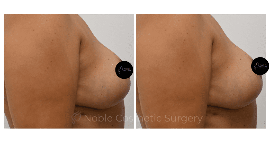BREAST-REDUCTION-CASE-00802 | Before and After Breast Reduction 2