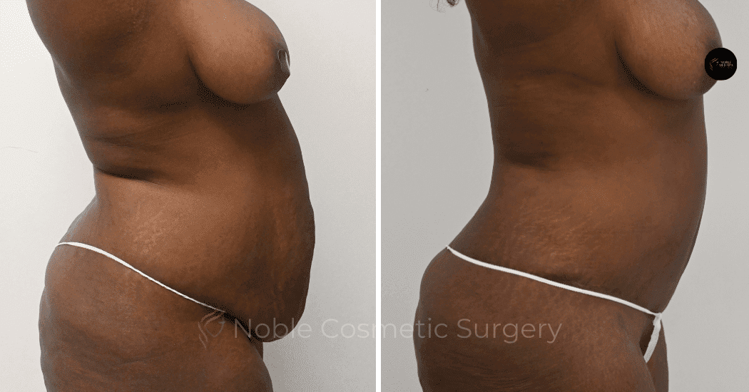 TUMMY-TUCK-CASE-10563 | Before and After Abdominoplasty 3