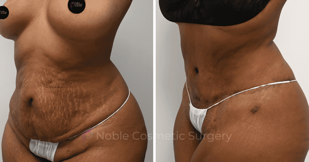TUMMY-TUCK-CASE-14814 | Before and After Abdominoplasty 3