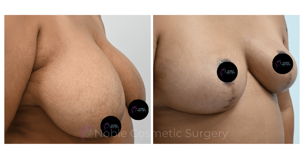 BREAST-REDUCTION-CASE-00803 | Before and After Breast Reduction 2