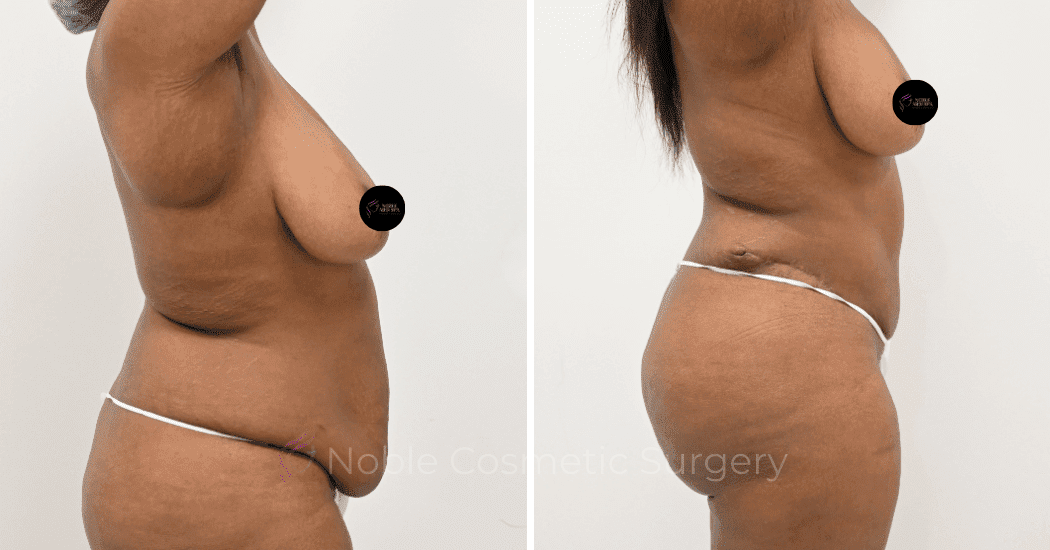 TUMMY-TUCK-CASE-13171 | Before and After Abdominoplasty 3