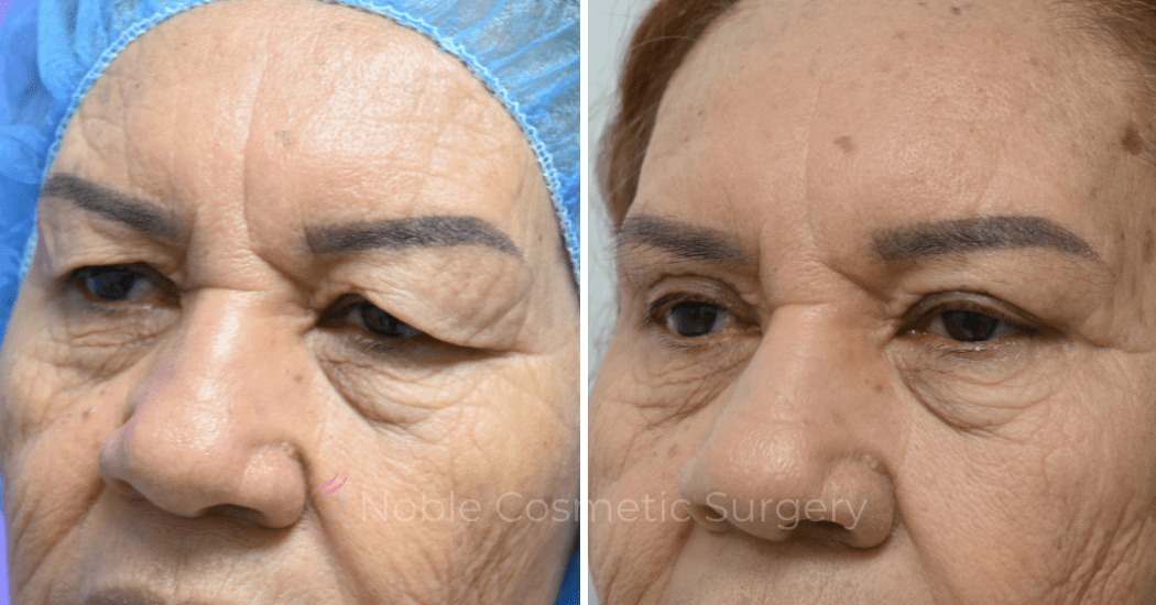 BLEPHAROPLASTY-CASE-10180 | Before and After Blepharoplasty 3