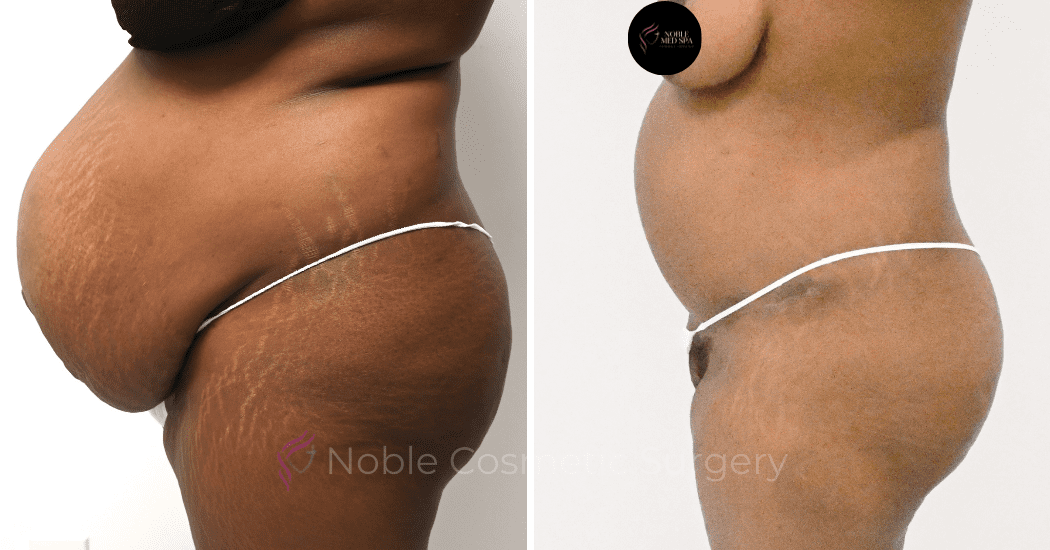 TUMMY-TUCK-CASE-11379 | Before and After Abdominoplasty 3