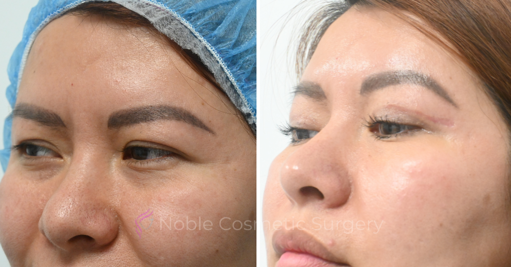 BLEPHAROPLASTY-CASE-10083 | Before and After Blepharoplasty 3
