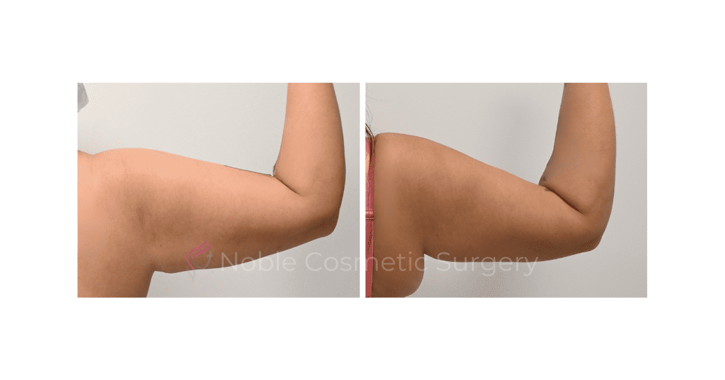 ARM-LIFT-CASE-15380 | Before and After Brachioplasty 3