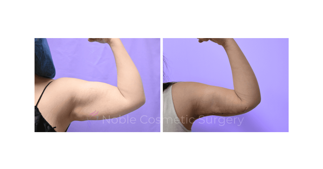 ARM-LIFT-CASE-19182 | Before and After Brachioplasty 6