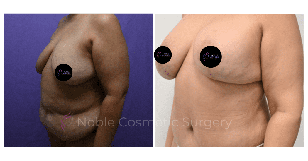 BREAST-REDUCTION-CASE-00220 | Before and After Breast Reduction 3