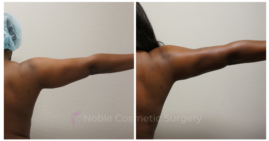 LIPOSUCTION-ARMS-CASE-00500 | Before and After Arm Liposuction 3
