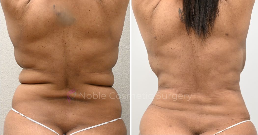 TUMMY-TUCK-CASE-00031 | Before and After Abdominoplasty 3