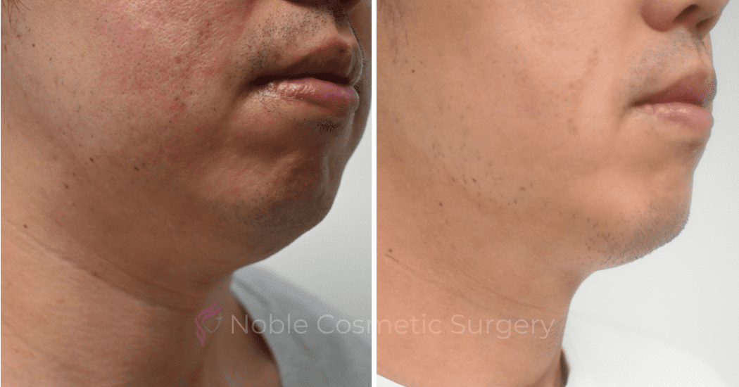SUBMENTAL-LIPOSUCTION-CASE-10214 | Before and After Chin Liposuction