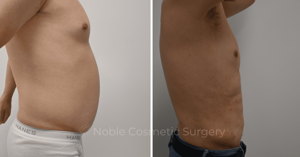 LIPOSUCTION-ABDOMEN-CASE-12252 | Before and After Male Liposuction 3