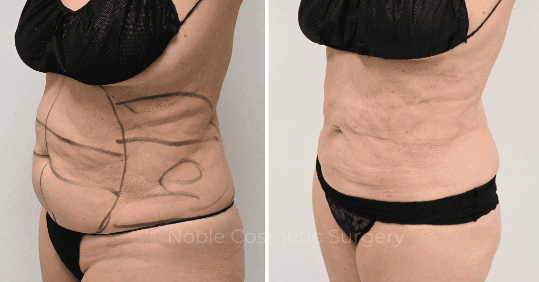 LIPOSUCTION-CASE-10145 | Before and After Liposuction 3