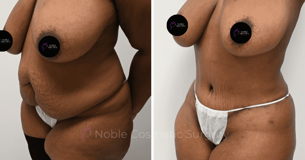TUMMY-TUCK-CASE-14435 | Before and After Abdominoplasty 4