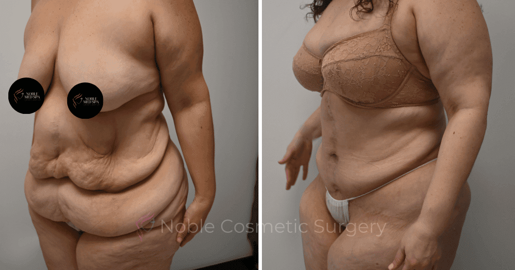 TUMMY-TUCK-CASE-10950 | Before and After Abdominoplasty 4