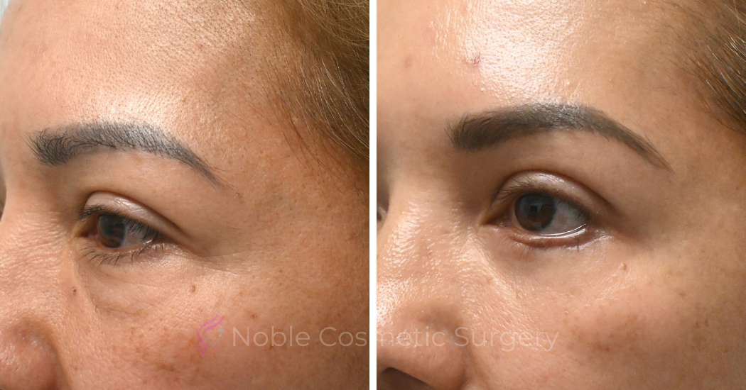 BLEPHAROPLASTY-CASE-19072 | Before and After Blepharoplasty 4