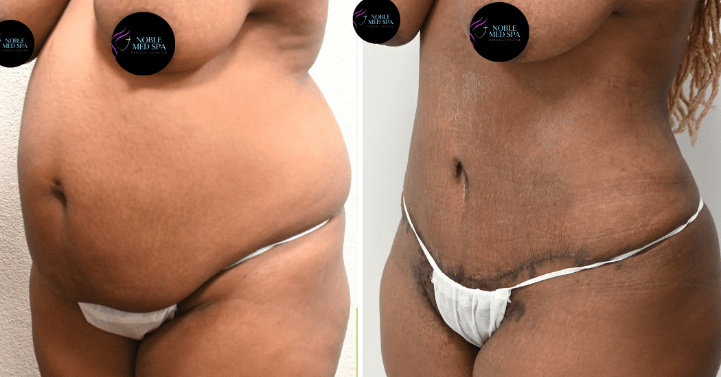 TUMMY-TUCK-CASE-13859 | Before and After Abdominoplasty 4