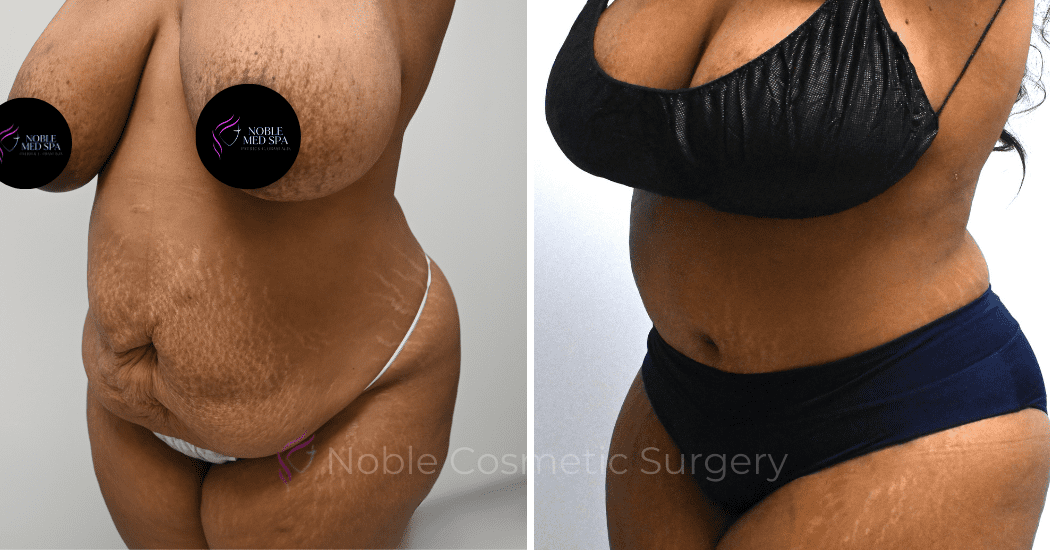 TUMMY-TUCK-CASE-14522 | Before and After Abdominoplasty 4