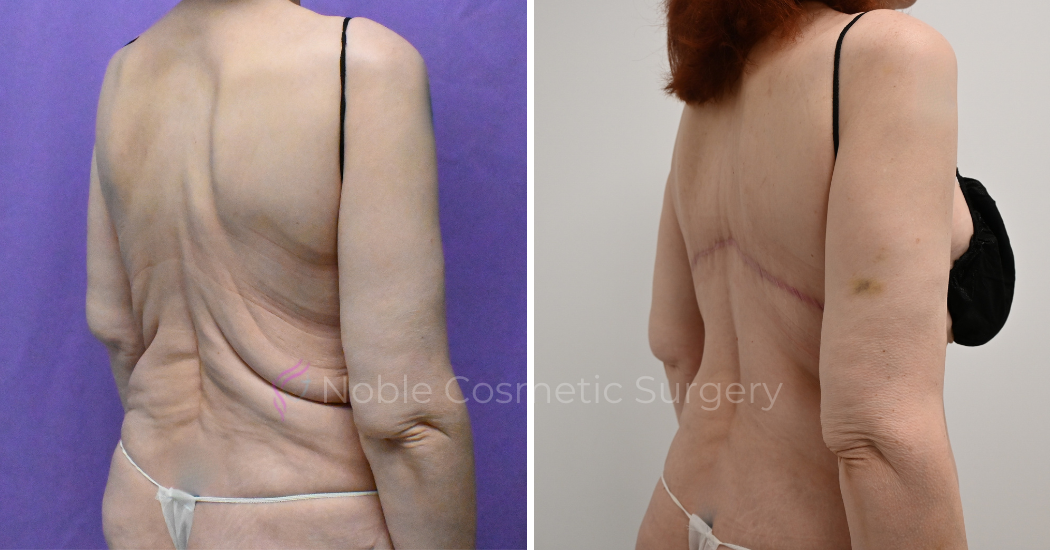 Case--12099 | Before and After Back Lift 4