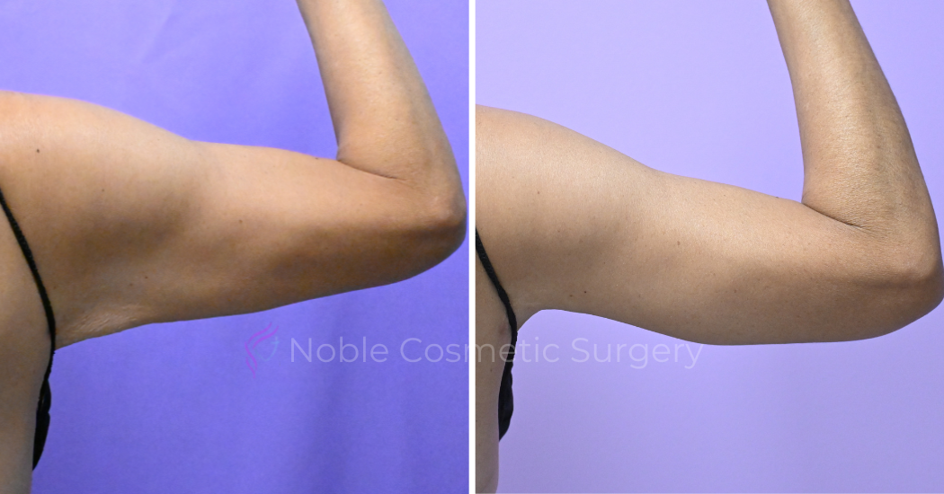 Case--20186 | Before and After Brachioplasty 4