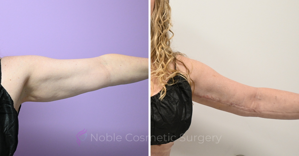 Case--20309 | Before and After Brachioplasty 4