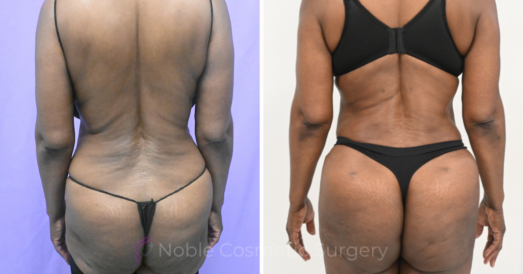 Case--19632 | Before and After Liposuction 4