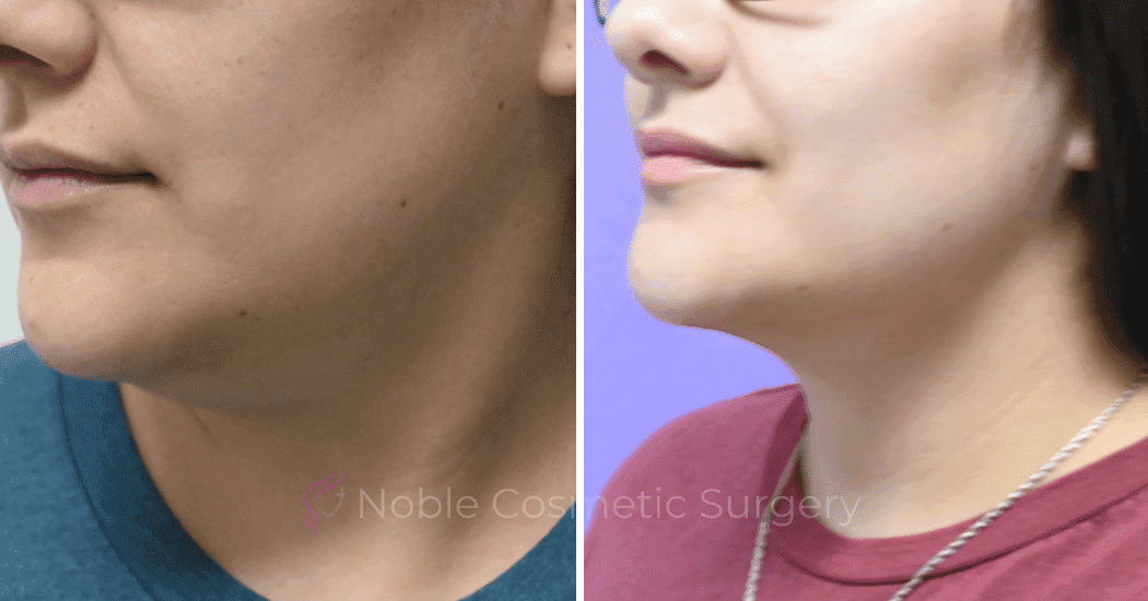 SUBMENTAL-LIPOSUCTION-CASE-10173 | Before and After Chin Liposuction 3