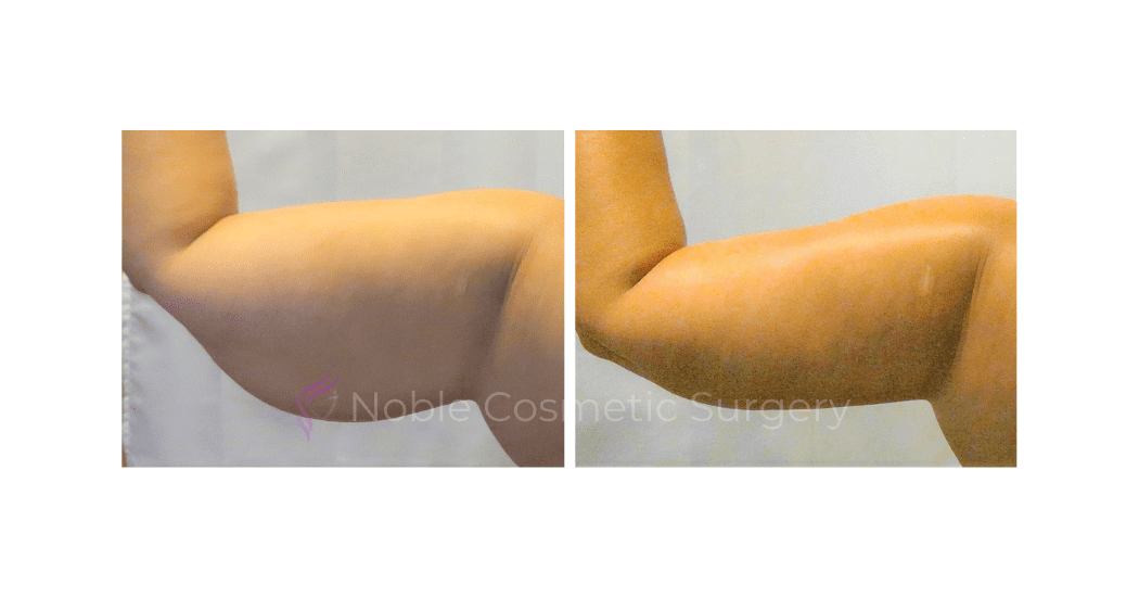 ARM-LIFT-CASE-19050 | Before and After Brachioplasty 3