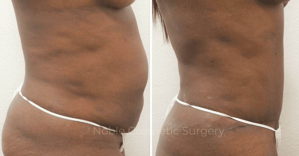 TUMMY-TUCK-CASE-00305 | Before and After Abdominoplasty 3