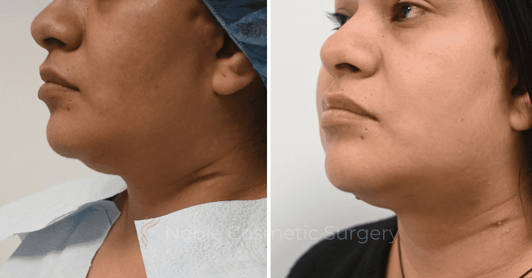 SUBMENTAL-LIPOSUCTION-CASE-10071 | Before and After Chin Liposuction 4