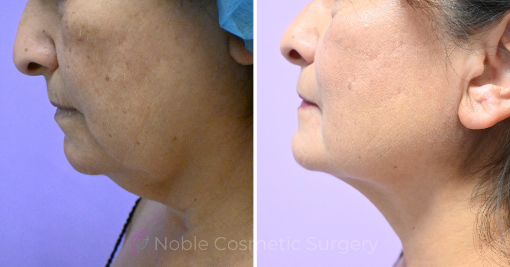 Case--19506 | Before and After Chin Liposuction 4