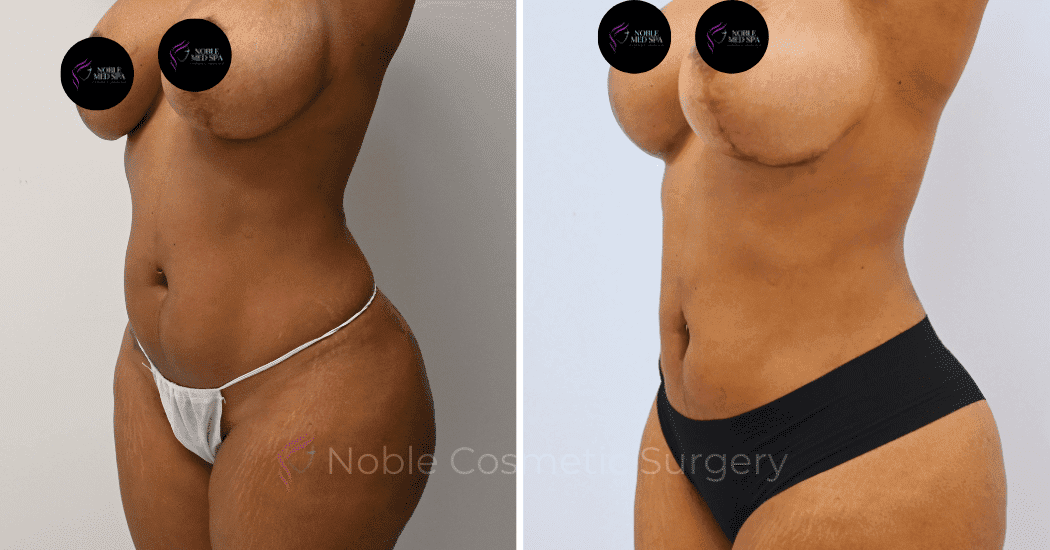 MOMMY-MAKEOVER-CASE-16458 | Before and After Mommy Makeover 4